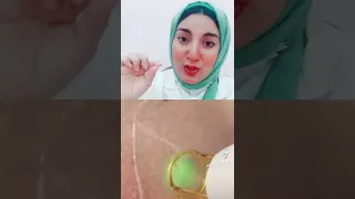 How Does Laser Hair Removal Burn Hair In The Same Session 