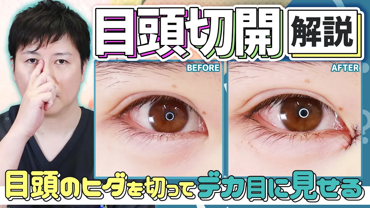 【目頭切開】ダウンタイムや傷跡は？適応のセルフチェック方法など症例写真も含めて徹底解説！【大阪TAクリニック】