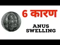 6 TOP REASONS - ANUS SWELLING ki