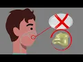 Home Sputum Collection - English Version