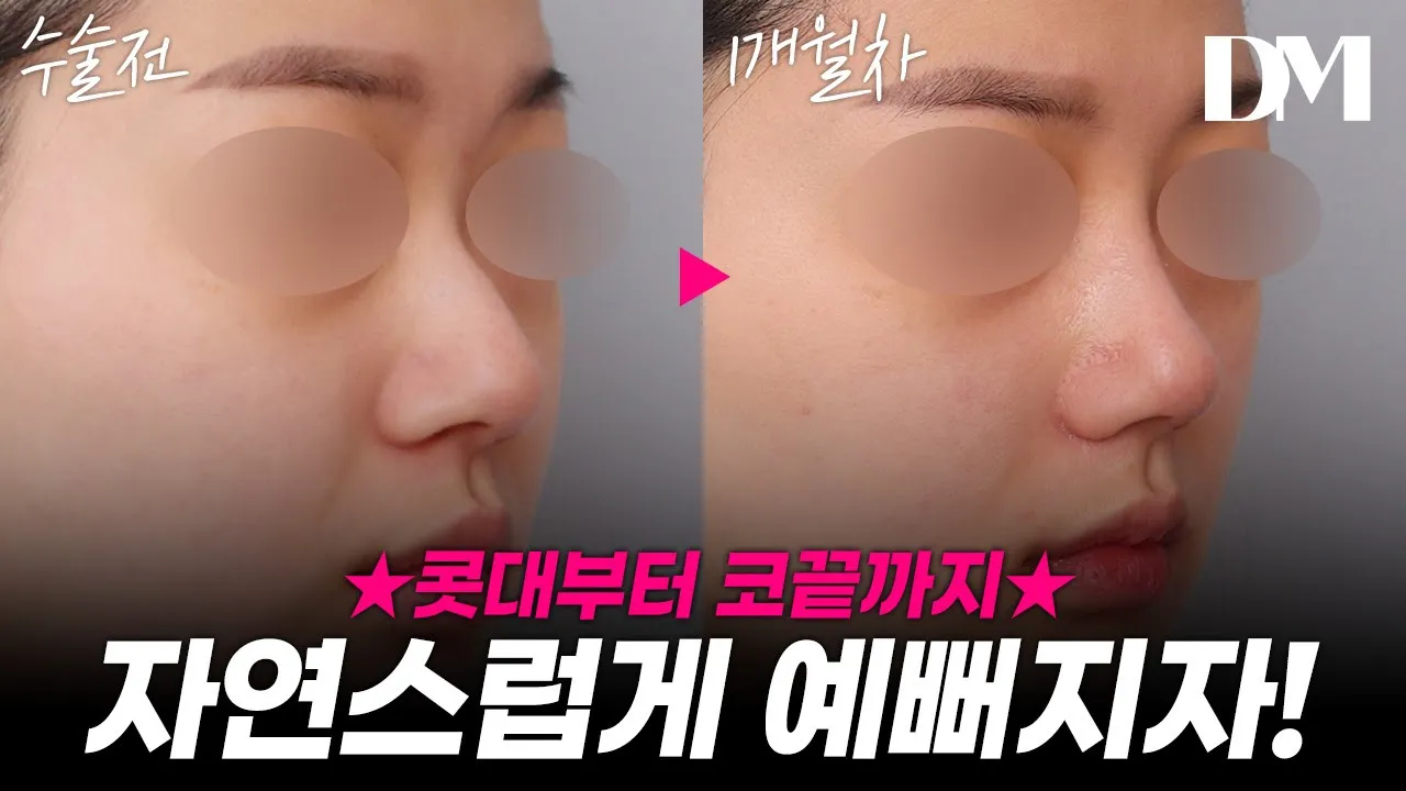 졸린 인상과 낮은 코끝.. 이렇게 해결하세요! [눈,코성형] #비절개눈매교정 #코성형 #눈매교정