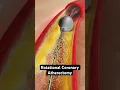Download Lagu Grinding plaque from coronary arteries (3D Animation)