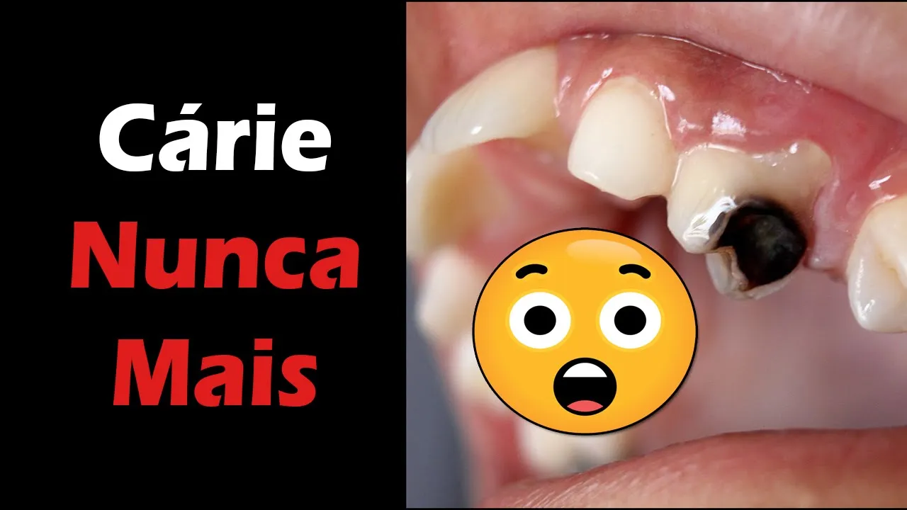 Como Evitar Cárie e Dor de Dente - NUNCA MAIS Tenha Estes Problemas
