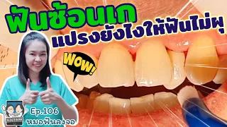 ทำไมฟันซ้อนเกถึงทำให้ทำความสะอาดยากและมีความเสี่ยงต่อโรคช่องปากมากกว่าคนทั่วไป