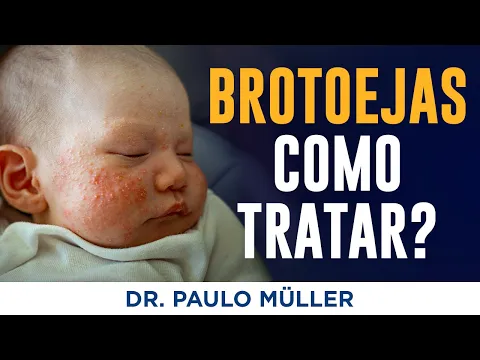 Download MP3 Brotoejas, Como Tratar? – Dr. Paulo Müller Dermatologista