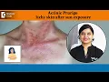 Download Lagu Can you be allergic to sunlight?|Actinic Prurigo|Itchy skin in summer-Dr.Amee Daxini|Doctors' Circle