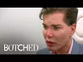 Dr Paul Nassif Says Patient s Nose Could Fall Off Botched E