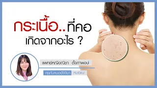  กระเนื้อและติ่งเนื้อเกิดจากอะไร และมีปัจจัยเสี่ยงอะไรบ้าง 