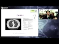 Lagu Surgery for Lung NETs - Dr. Carmine Simone (Thoracic Surgeon)