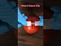 Stitchless Healing ZipStitch Wound Closure in 14 Seconds