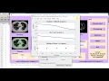 Lung Cancer Detection using Machine Learning