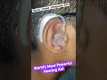 Download Lagu Oticon Xceed Ultrapower Behind The Ear Hearing Aid for Severe \u0026 Profound Hearing Loss| Most Powerful