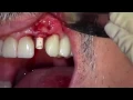 Download Lagu Klipod Recording of Dental Implant Surgery - #10, legacy