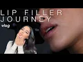 Lip Filler Journey Update