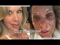 Skin resurfacing Groupon carbon dioxide laser medspa