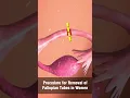 Download Lagu Procedure for Removal of Fallopian Tubes in Women | Best IVF Centre in Kanpur