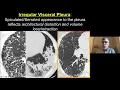 Consolidation and Ground Glass - Imaging Approach to Fibrosis