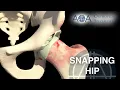 AOA Orthopedic Specialists - Snapping Hip