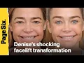 Denise Richards shares wild before-and-after photos of shocking facelift transformation
