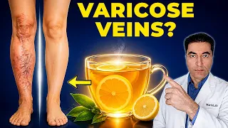 varicose veins after 50 drink this lemon tea daily