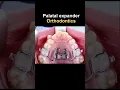 Expander jaw when orthodontics