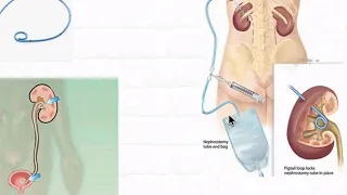 Acute Chronic Pyelonephritis Pyonephrosis Peri-nephric Abscess Renal Tuberculosis Surgery