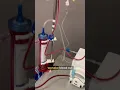 How to detox your blood EBOO patient walkthrough