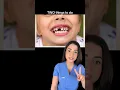 KNOCKED OUT baby tooth what to do