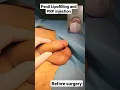 Download Lagu Penil lipofilling and PRP injection by Dr Araz Bayramov #penil #penis penilenlargement.com