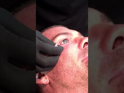 RAW FOOTAGE Rich getting his dermal piercing removed.#RichPiana #5PercentNutrition #Piercing #Dermal