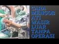 Download Lagu Cara mengobati wasir luar tanpa operasi