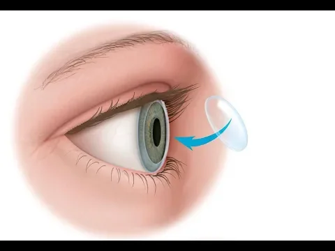 Santa Catarina é referência em transplante de córneas, aponta relatório