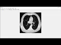 Lung Nodule Detection Deep Learning Matlab Projects