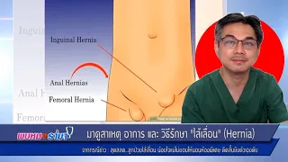 ไส้เลื่อนคืออะไร และเกิดจากสาเหตุใด