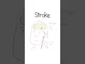 Download Lagu Strokes Explained #healthsketch #shorts