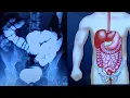 All About Health - Redundant Colon