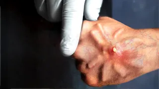 it started as a spider bite then it grew..