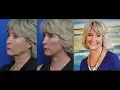 Susan s Facelift Transformation Story
