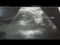 Baby Eunbin 은빈 a half korean baby was born in PERPETUAL HOSPITAL IN CEBU