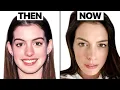 Truth Behind Anne Hathaway Look Plastic Surgery Analysis