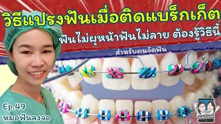 ทำไมคนที่จัดฟันต้องแปรงฟันให้ดีขึ้นกว่าปกติ และมีวิธีการแปรงอย่างไรที่แตกต่างจากคนทั่วไป