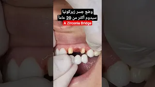 جسر وتلبيسات زيركونيا بعد عملية خلع الاسنان 