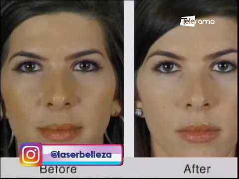 Estética al Día: Cejas disminución y levantamiento