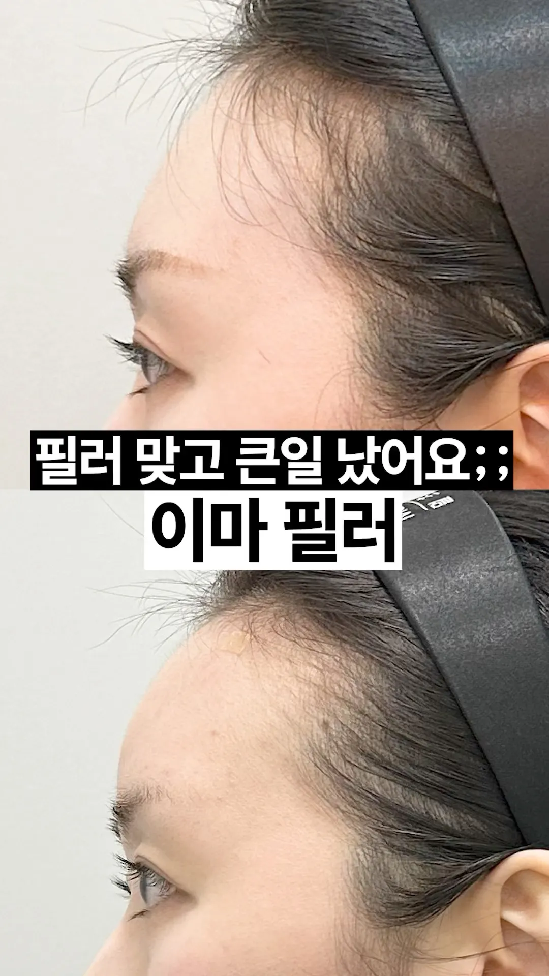 필러로 윤곽 정리했습니다 💫