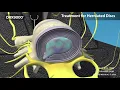 What is Spinal Decompression DRX9000 for low back pain sciatica and herniated disc Avoid Surgery