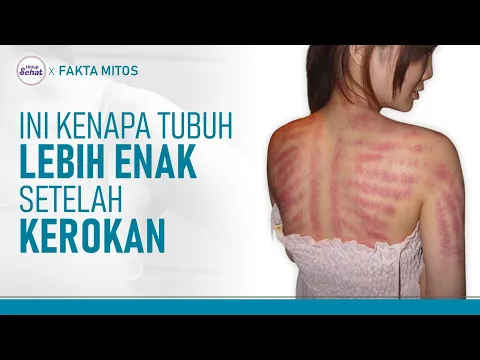 Penjelasan Medis Seputar Kerokan, Baik kah Untuk Kesehatan?