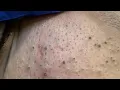 Satisfying Pore Extraction ASMR Big Whitehead Blackhead Removal