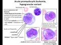 Acute promyelocytic leukemia APL Definition Causes symptoms Diagnosis Treatment