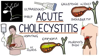 understanding acute cholecystitis