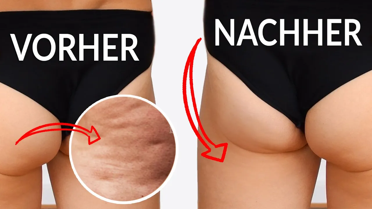 Mit diesen 10 effektiven Tricks wirst du Cellulite einfach los(40 Jahre & 2 fach Mama)